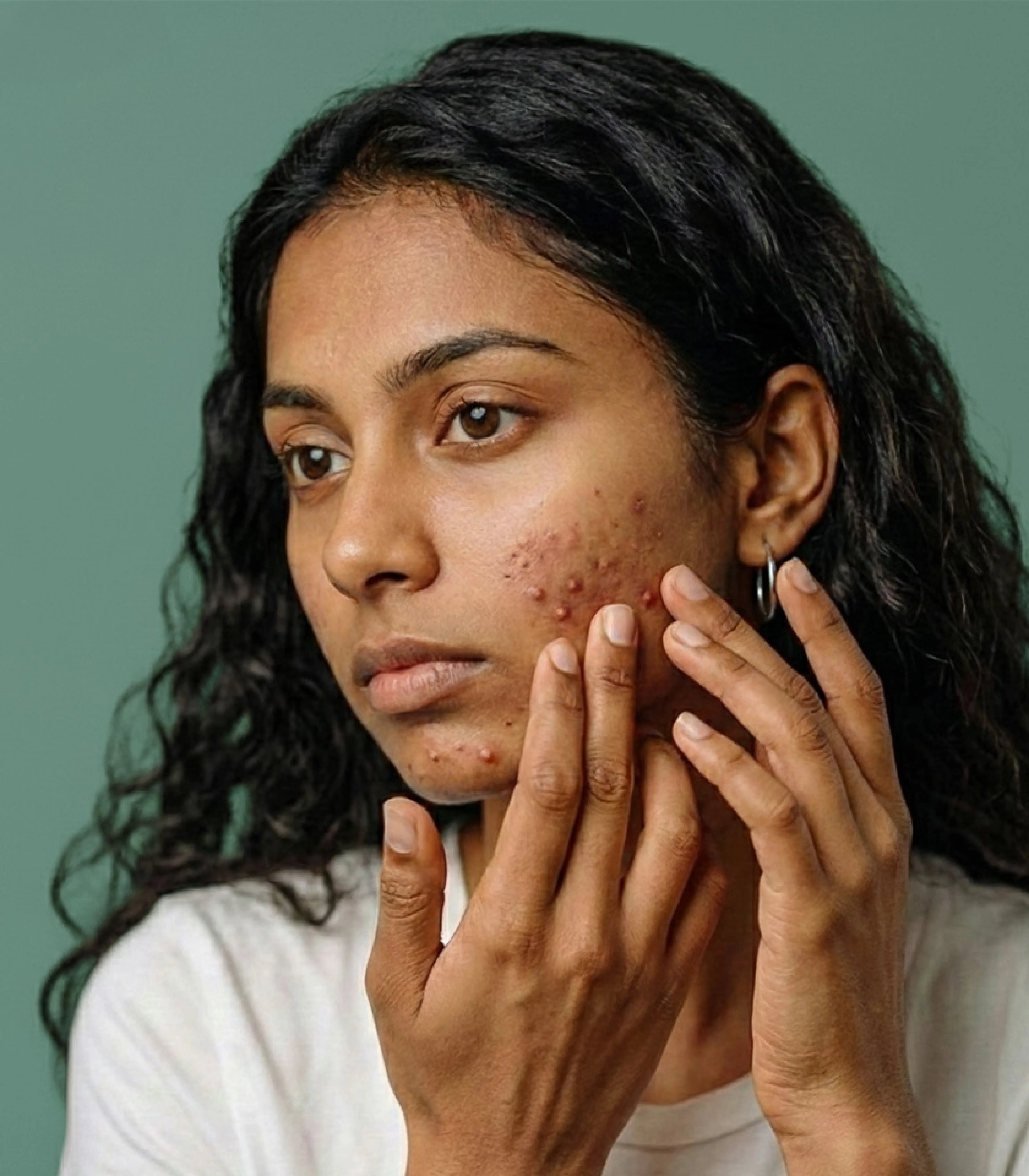 Acne and breakouts treatment